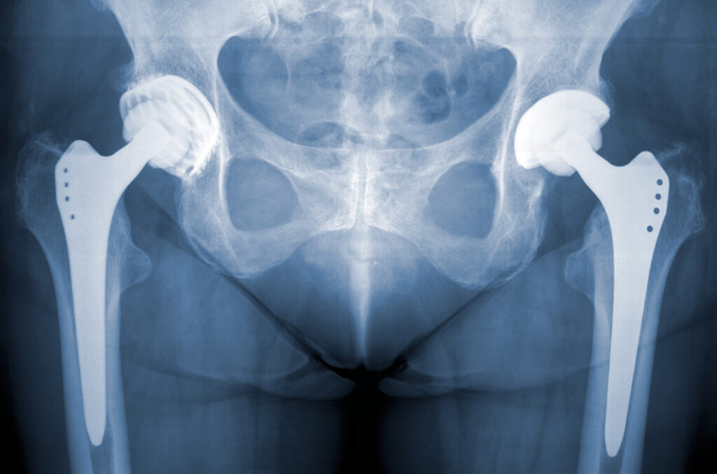 Understanding Hip Fractures: Types, Causes & Treatment